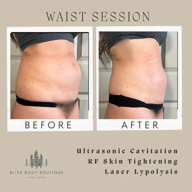 Before and after waist-session photos shared on Instagram