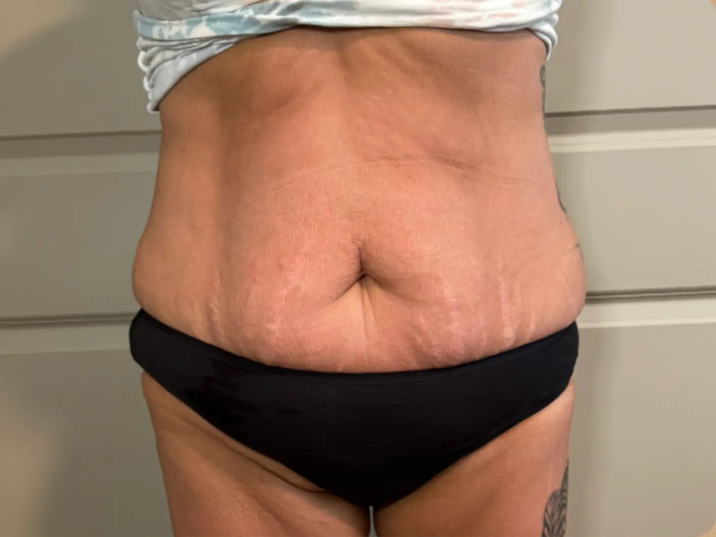 Waist slimming, after 3 sessions