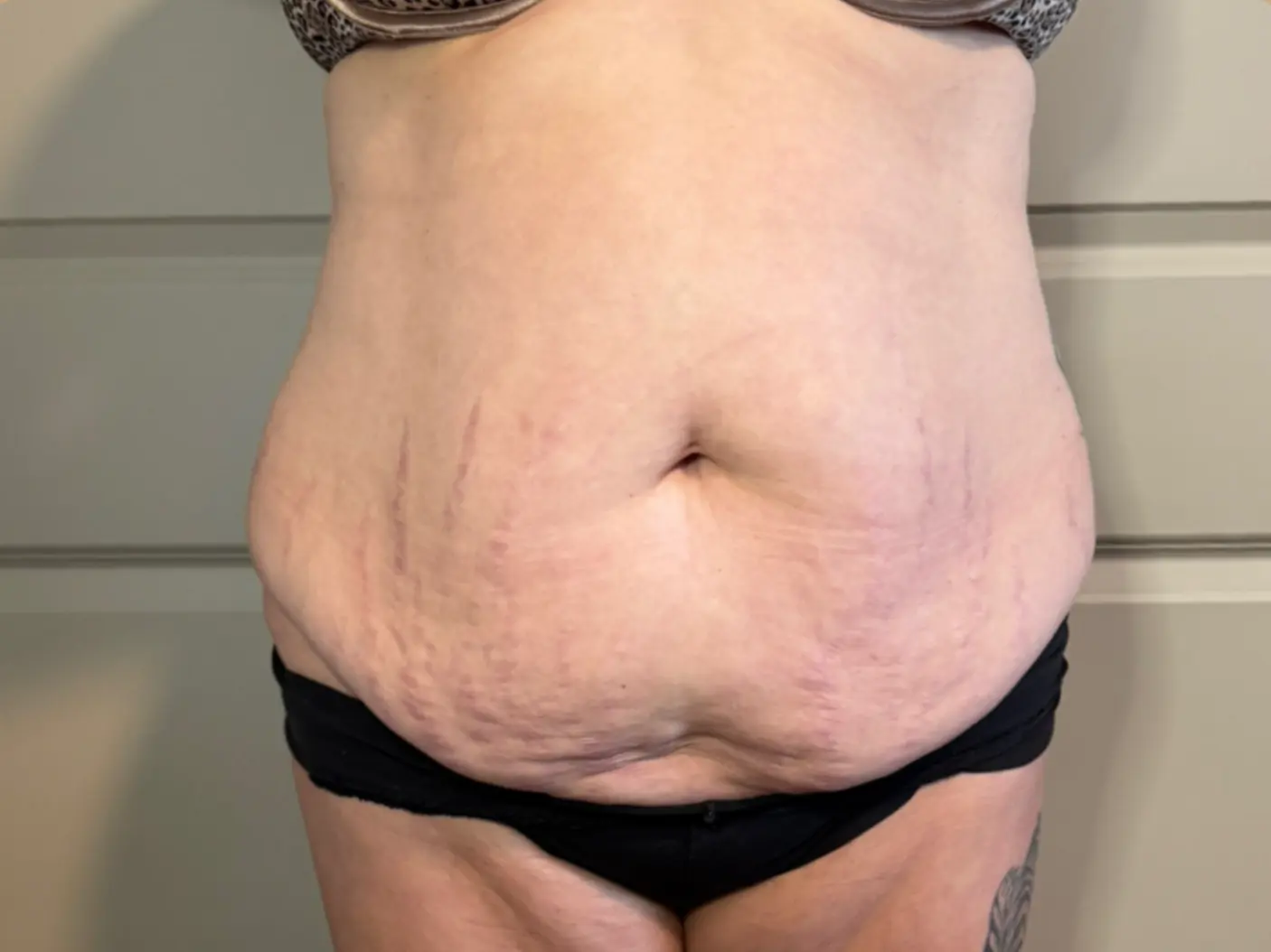 Waist slimming, before treatment